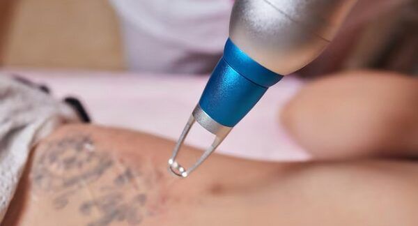 Las 10 mejores clínicas para eliminar tatuajes en Barcelona