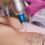 Las 10 mejores clínicas para eliminar tatuajes en Madrid